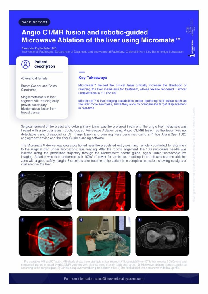 Micromate Case Study Liver Ablation EN